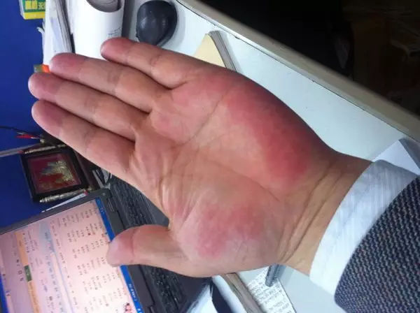 丙肝可以补硒吗(补硒可以丙肝疫苗打吗)-硒宝网