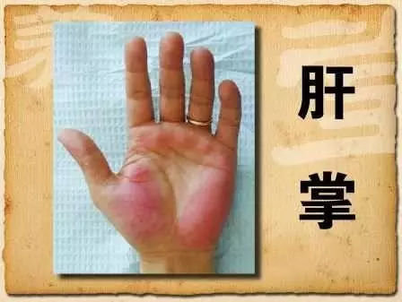 丙肝可以补硒吗(补硒可以丙肝疫苗打吗)-硒宝网