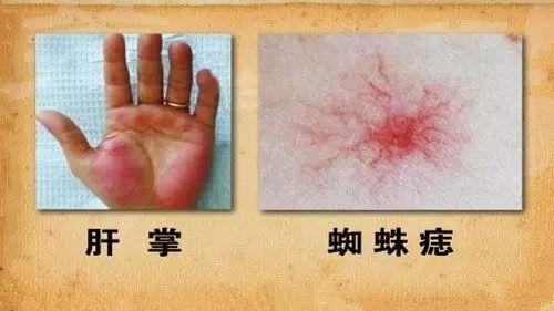 丙肝可以补硒吗(补硒可以丙肝疫苗打吗)-硒宝网