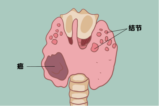 甲状腺病要补硒（甲状腺疾病补硒）-硒宝网