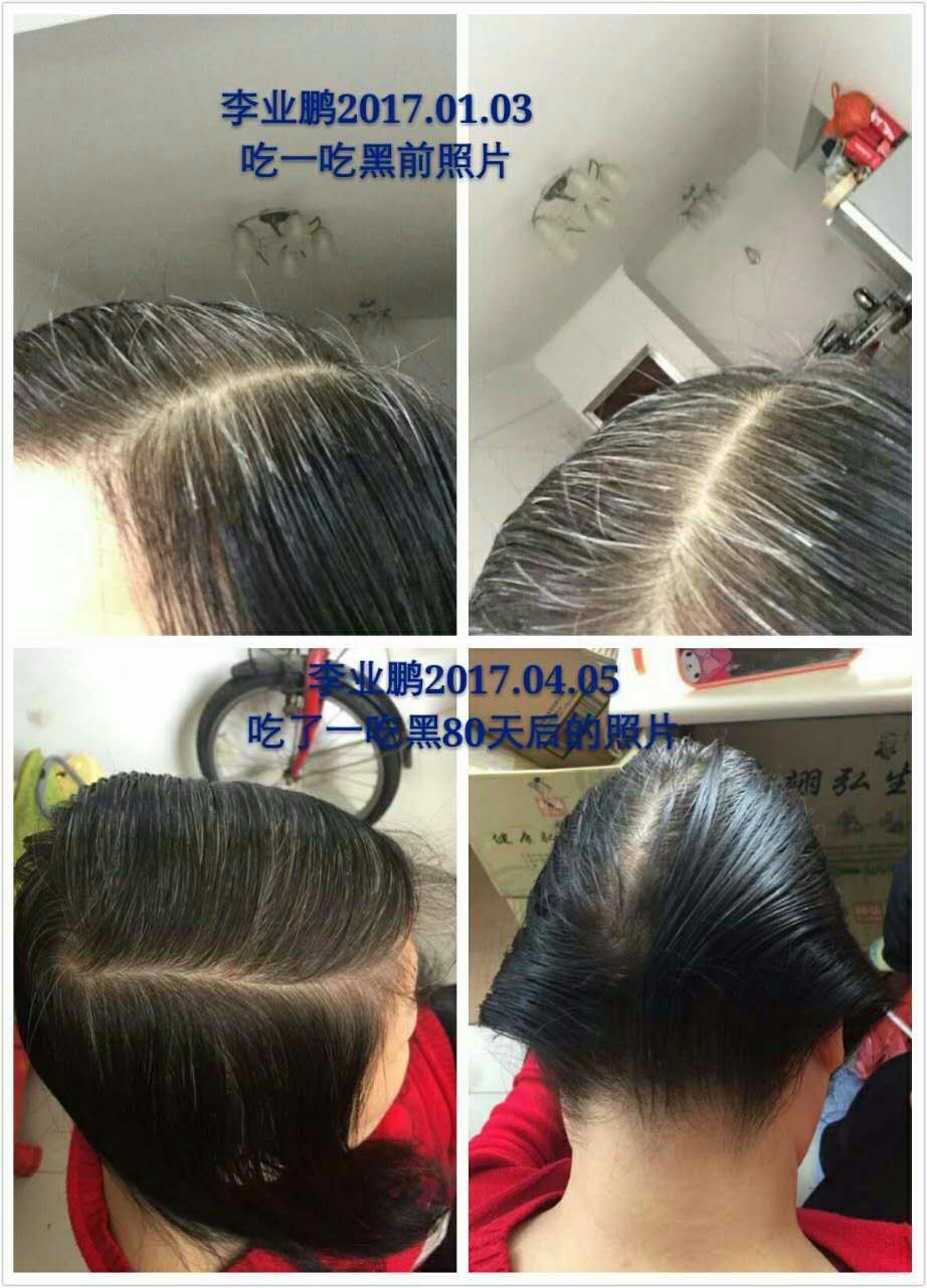 补硒后白发变黑（白发补变黑硒后会变白吗）-硒宝网