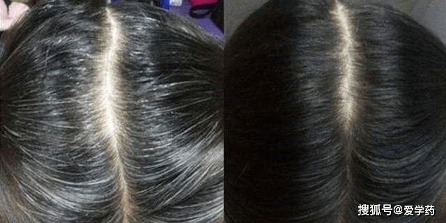 补硒后白发变黑（白发补变黑硒后会变白吗）-硒宝网