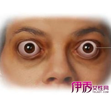 甲亢为什么补硒(甲亢补硒能减少复发吗)-硒宝网