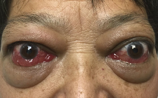 甲亢为什么补硒(甲亢补硒能减少复发吗)-硒宝网