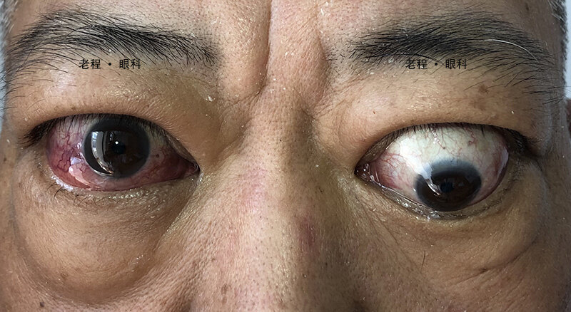 甲亢为什么补硒(甲亢补硒能减少复发吗)-硒宝网