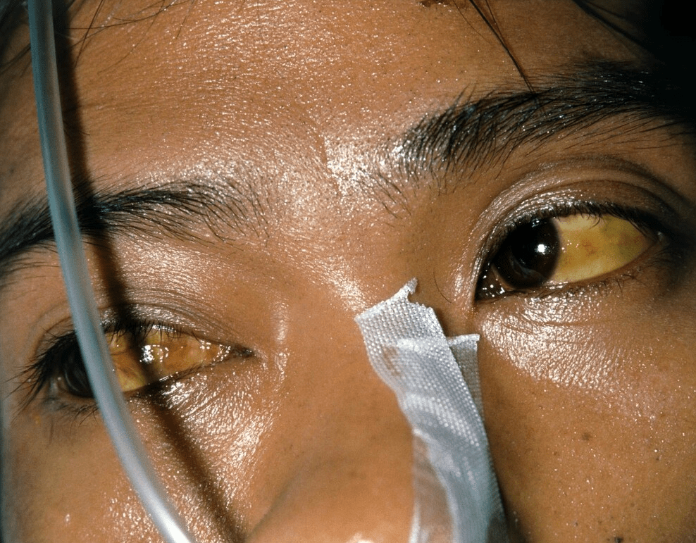 补硒后眼睛发黄(补硒后对眼睛的作用)-硒宝网