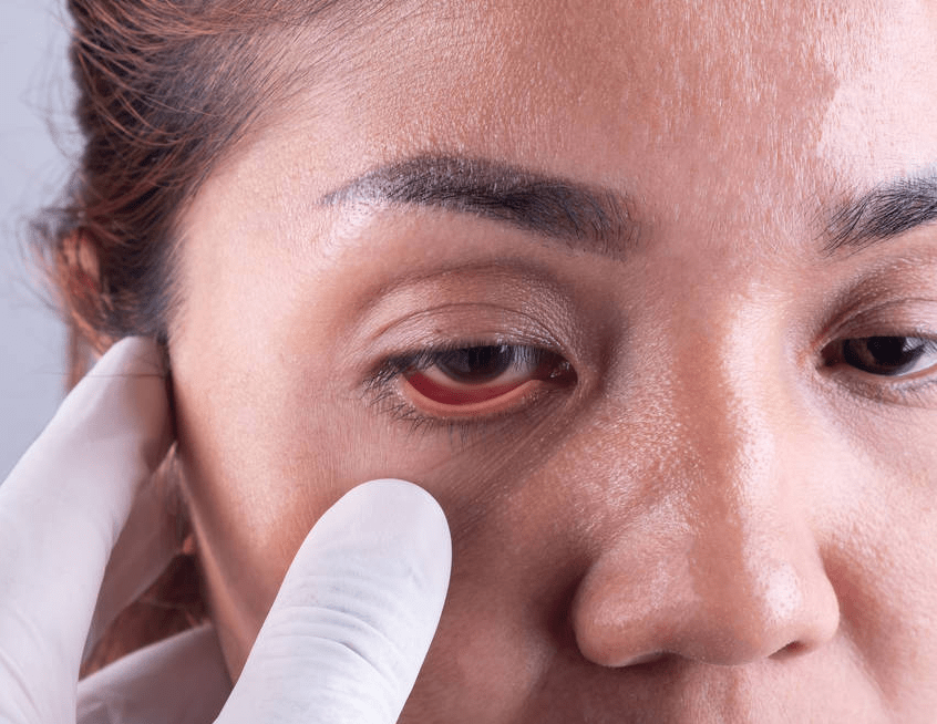 补硒后眼睛发黄(补硒后对眼睛的作用)-硒宝网