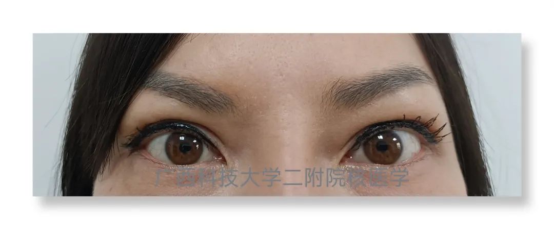 甲亢突眼 补硒(甲亢突眼吃硒酵母片有什么作用)-硒宝网