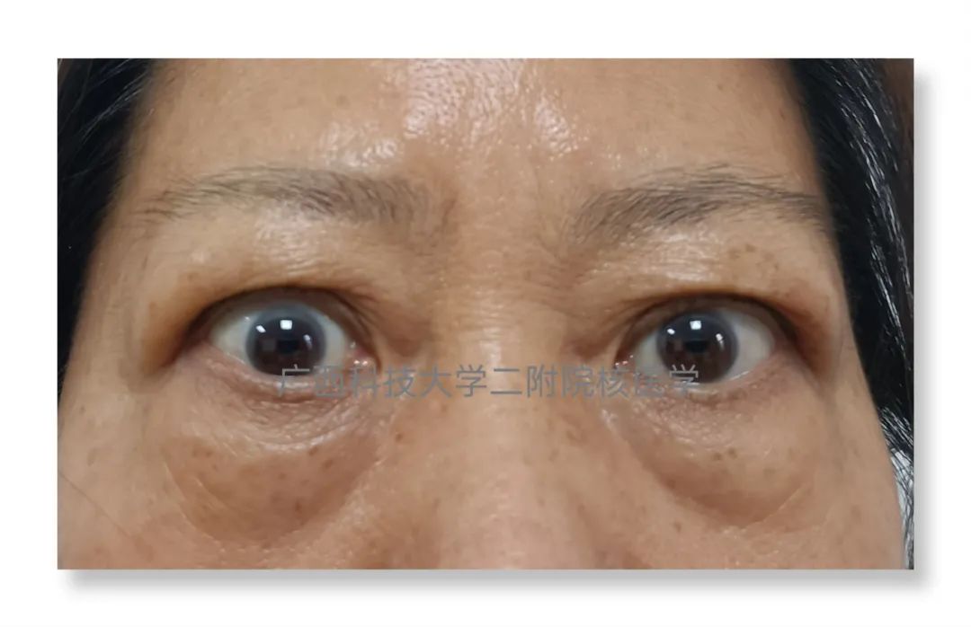 甲亢突眼 补硒(甲亢突眼吃硒酵母片有什么作用)-硒宝网