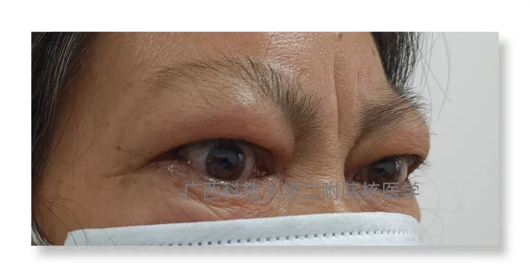 甲亢突眼 补硒(甲亢突眼吃硒酵母片有什么作用)-硒宝网