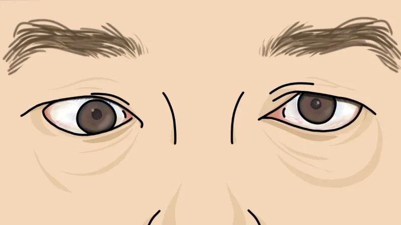 甲亢突眼 补硒（甲亢突眼为什么要吃硒酵母）-硒宝网