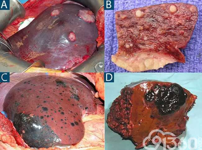 肝硬化补硒好吗（肝硬化补硒有没有效果）-硒宝网