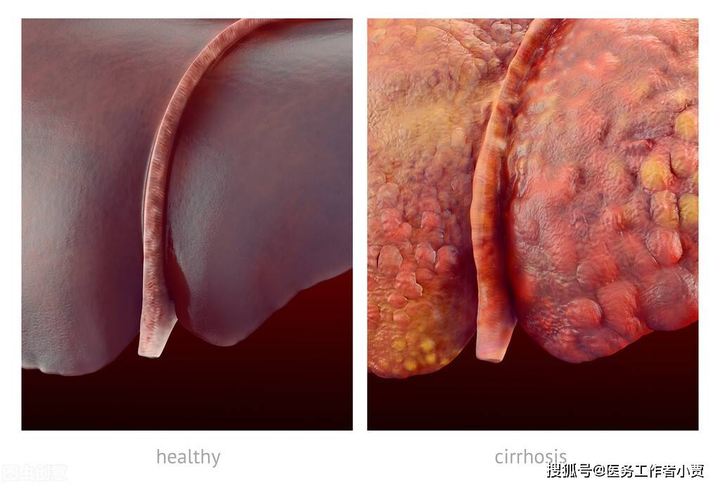 肝硬化补硒好吗（肝硬化补硒有没有效果）-硒宝网