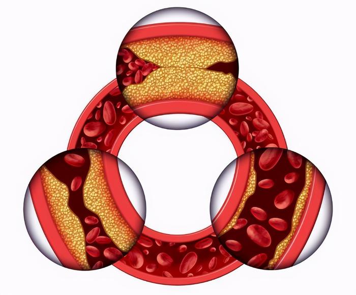 补硒预防脑出血（出血脑预防补硒吃什么药）-硒宝网
