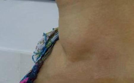 甲亢补硒脖子疼（脖子甲亢吃什么药）-硒宝网