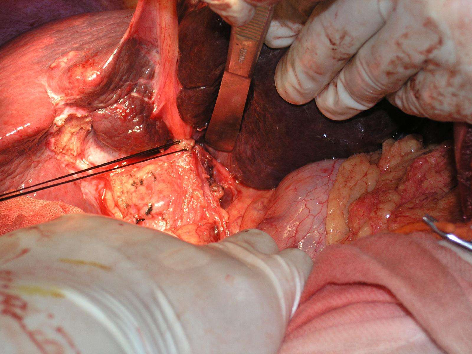 中度脂肪肝补硒（肝脂肪中度补硒有效果吗）-硒宝网