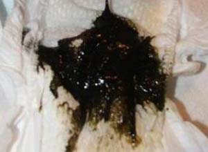 补铁拉屎会是黑色的吗（黑色拉屎补铁会是黑便吗）-硒宝网