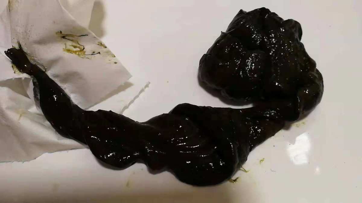 补铁拉屎会是黑色的吗（黑色拉屎补铁会是黑便吗）-硒宝网