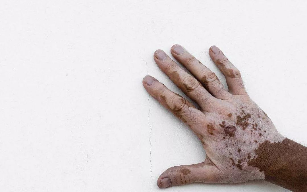 补硒会导致贫血(补硒过量会影响月经吗)-硒宝网