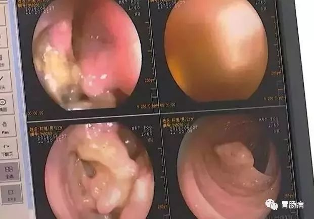 直肠癌晚期补硒(晚期补直肠癌硒片有用吗)-硒宝网