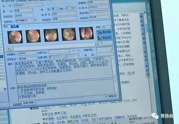 直肠癌晚期补硒(晚期补直肠癌硒片有用吗)-硒宝网