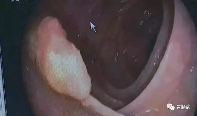 直肠癌晚期补硒(晚期补直肠癌硒片有用吗)-硒宝网