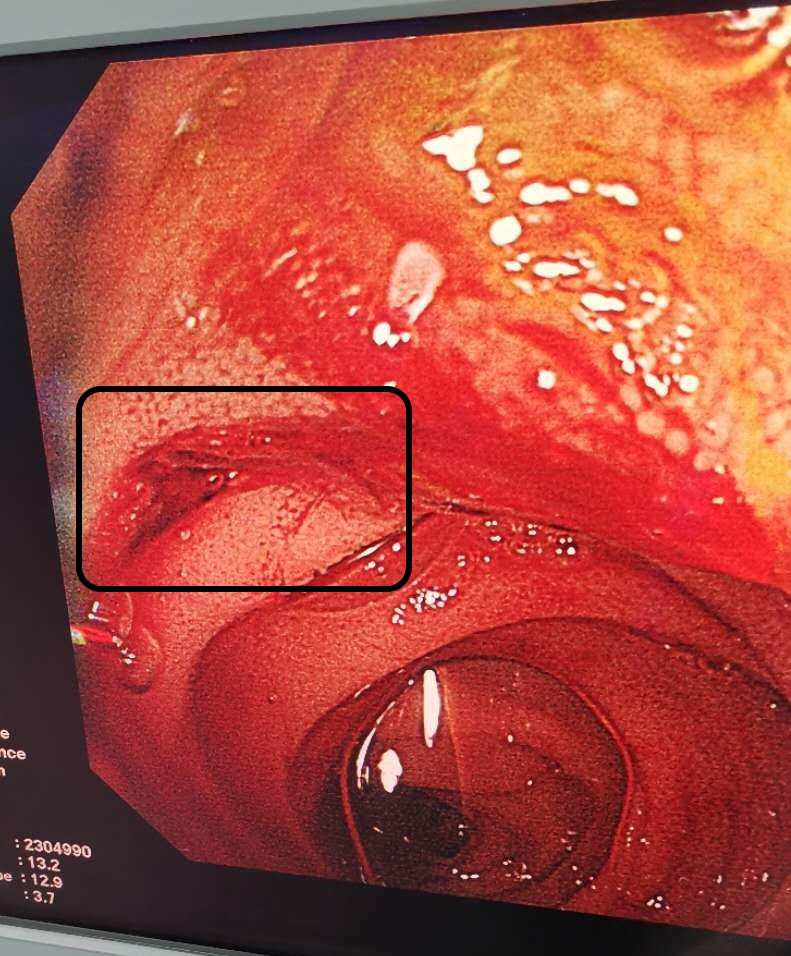 补硒大便会黑吗(吃硒大便黑色)-硒宝网