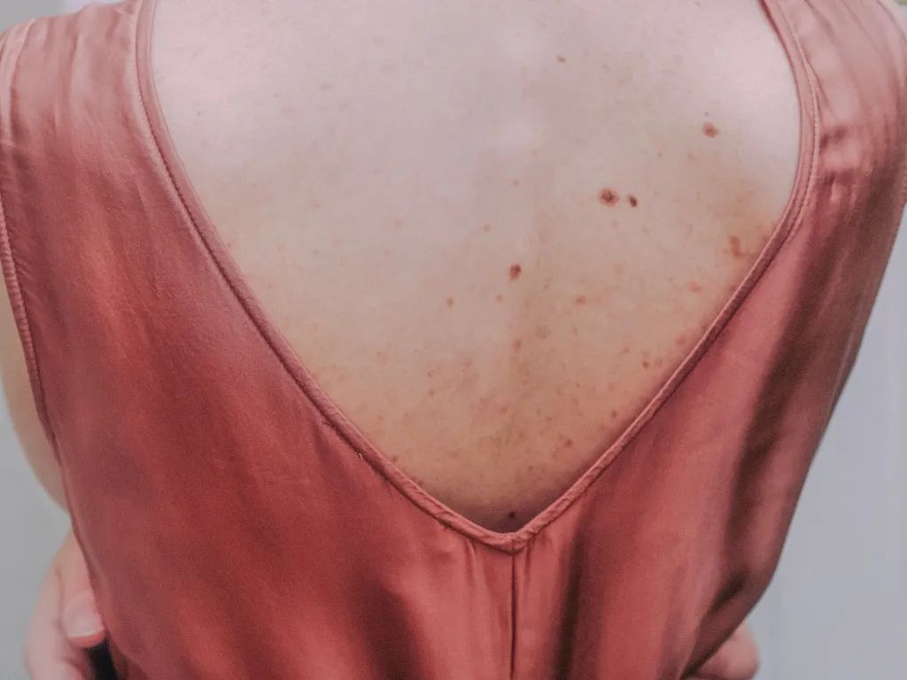 长痤疮要补硒吗(痤疮为什么要用硒酵母片)-硒宝网