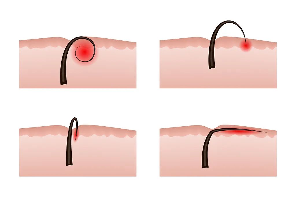 长痤疮要补硒吗(痤疮为什么要用硒酵母片)-硒宝网