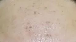 长痤疮要补硒吗(痤疮补长硒要吃多久)-硒宝网