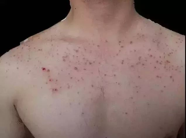 长痤疮要补硒吗(痤疮补长硒要吃多久)-硒宝网