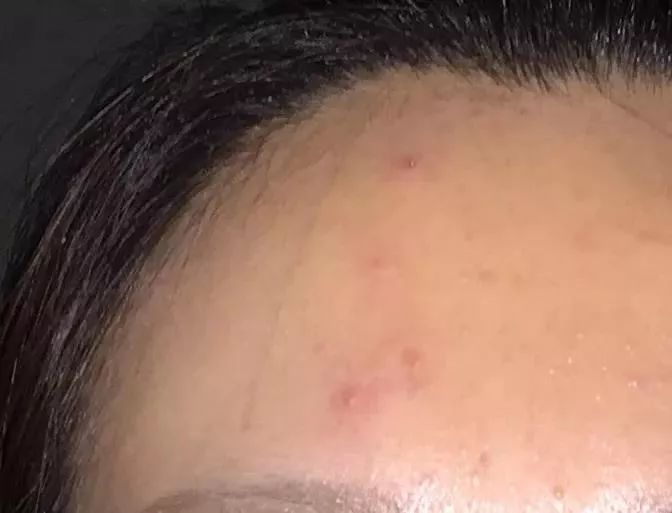 长痤疮要补硒吗(痤疮补长硒要吃多久)-硒宝网