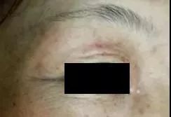 长痤疮要补硒吗(痤疮补长硒要吃多久)-硒宝网