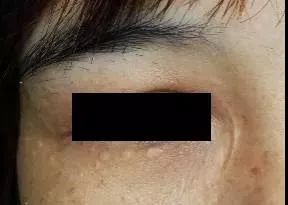 长痤疮要补硒吗(痤疮补长硒要吃多久)-硒宝网