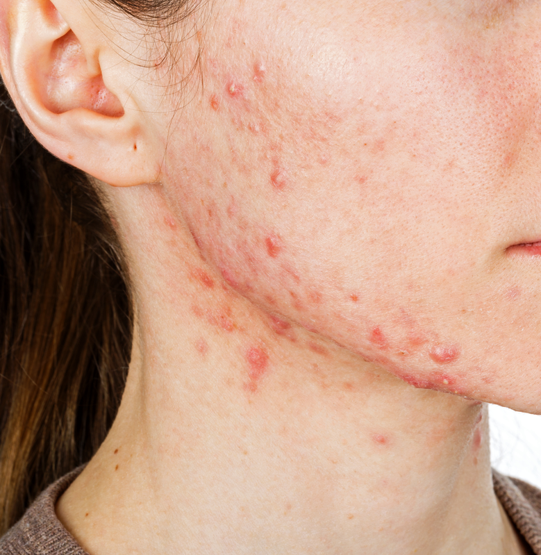 长痤疮要补硒吗(硒痤疮)-硒宝网