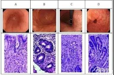 浅表性胃炎补硒(浅表性胃炎能吃硒吗)-硒宝网