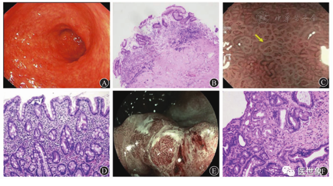 浅表性胃炎补硒(浅表性胃炎能吃硒吗)-硒宝网