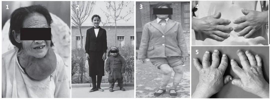 补硒防治克山?。ㄎ钥松讲〉淖饔茫?硒宝网