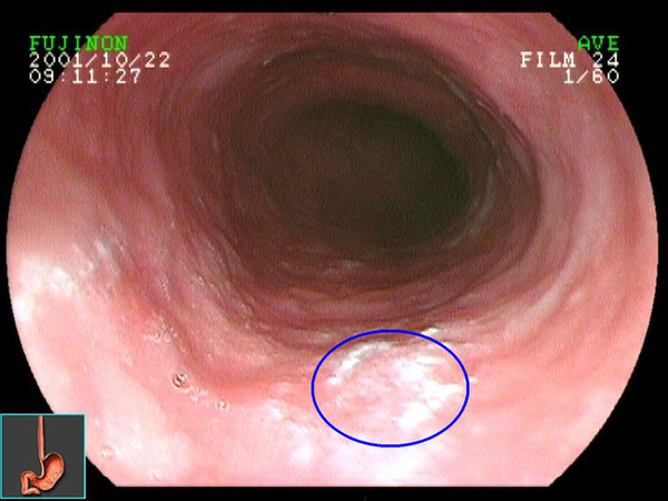 食道癌如何补硒（硒食道癌）-硒宝网