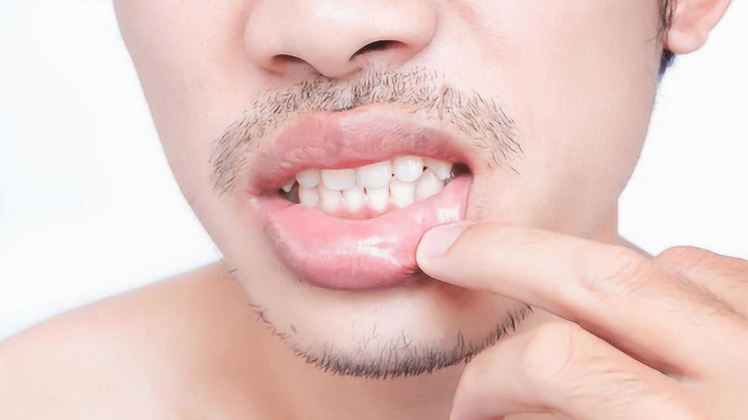 口腔溃疡要补硒(口腔补溃疡硒要吃多久)-硒宝网