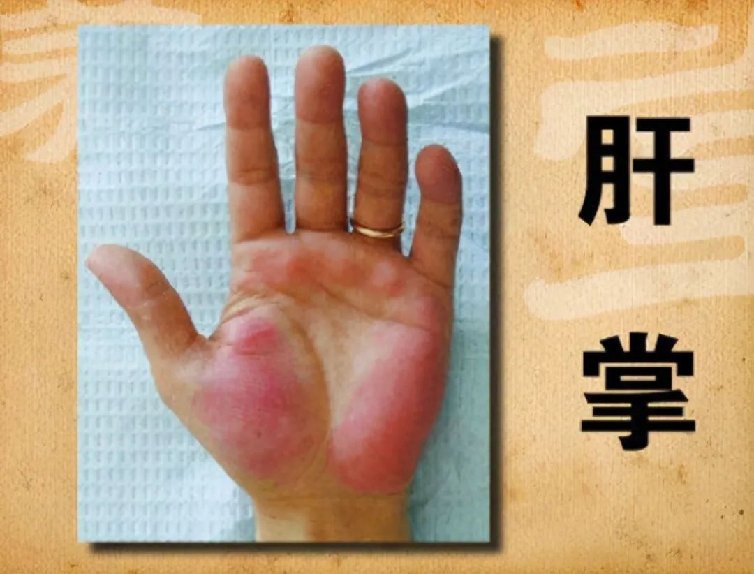 补硒对肝掌有用(补硒养肝)-硒宝网