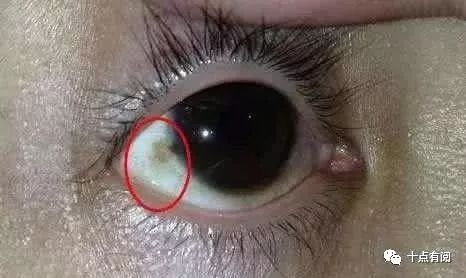 补硒对肝掌有用（补硒对肝病有效吗）-硒宝网