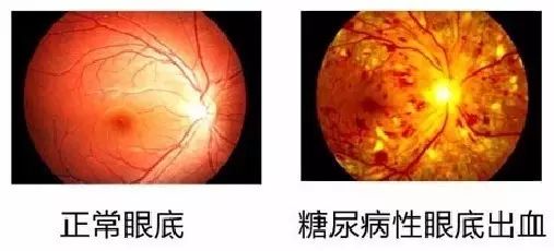 补硒预防糖尿?。ㄔし啦〔固悄蛭姆椒ǎ?硒宝网