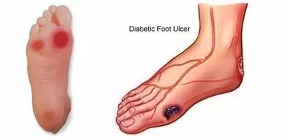 补硒预防糖尿病（预防病补糖尿硒的方法）-硒宝网