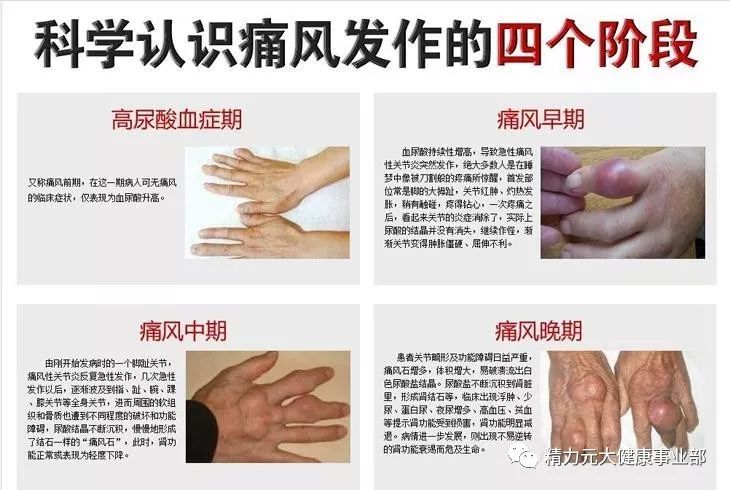 尿酸高可补硒吗（尿酸高吃硒行吗）-硒宝网