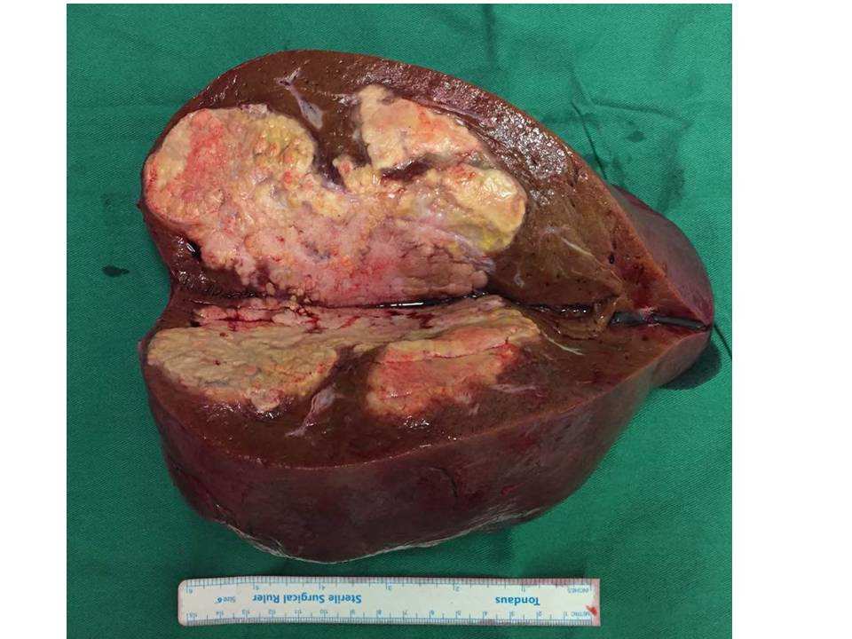肝硬化可补硒吗(硒对肝硬化)-硒宝网