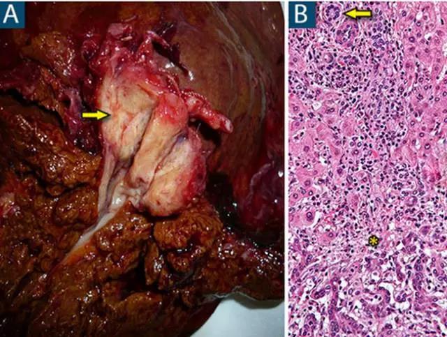 肝硬化可补硒吗(硒对肝硬化)-硒宝网