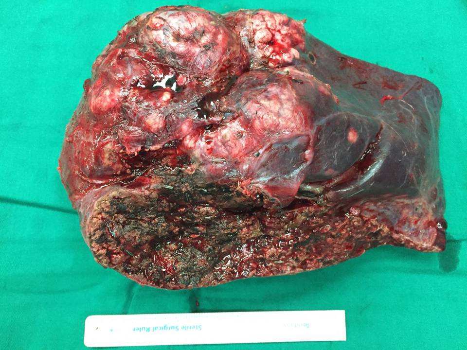 肝硬化可补硒吗(硒对肝硬化)-硒宝网