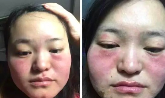 补硒会长痘痘吗(痘痘会长补硒的东西吗)-硒宝网