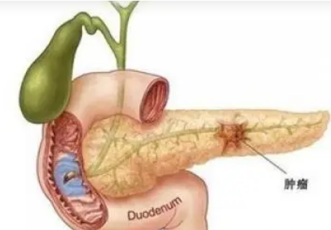胰腺癌晚期补硒(胰腺癌补硒有什么好处)-硒宝网